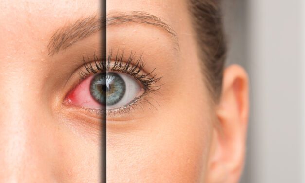 July is National Dry Eye Awareness Month