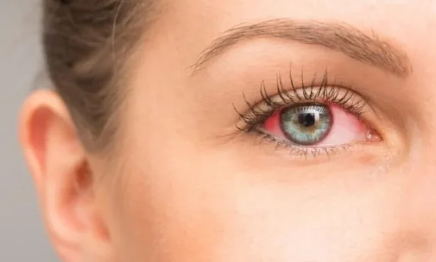 Do I Have Dry Eyes?