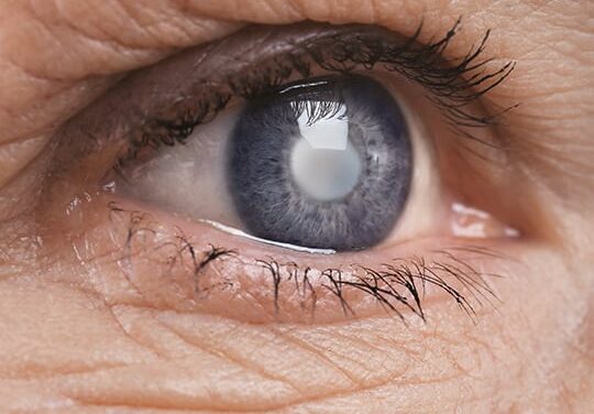 A Complete Guide To Glaucoma