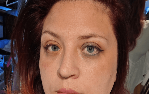After years of severe dry eye symptoms, a patient finally finds relief