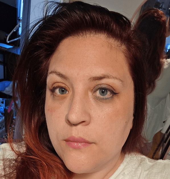 After years of severe dry eye symptoms, a patient finally finds relief