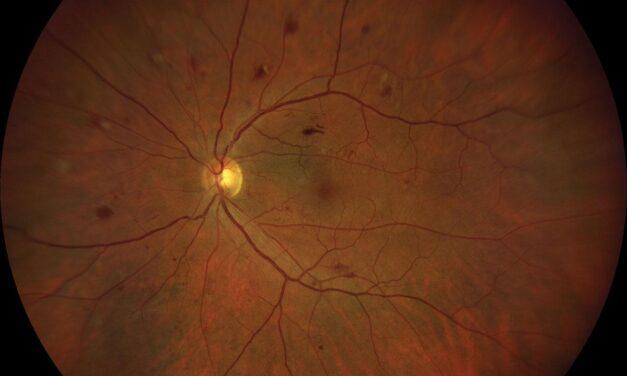 Sleep Duration Tied to Diabetic Kidney and Nerve Complications, but Not DR