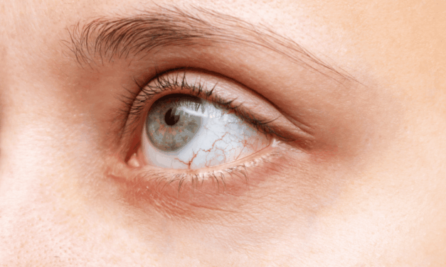 A Personalized Approach to Diagnosis and Treatment Is Changing Dry Eye Management