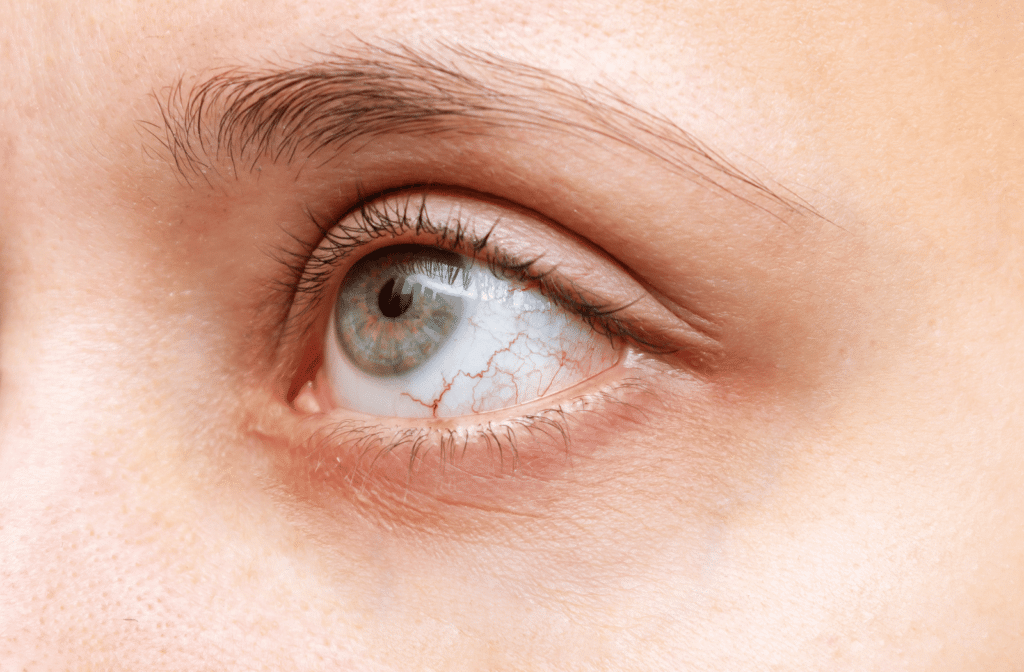 A Personalized Approach to Diagnosis and Treatment Is Changing Dry Eye Management