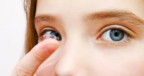 Acuvue Abiliti 1-Day lenses show 3-year myopia control effect