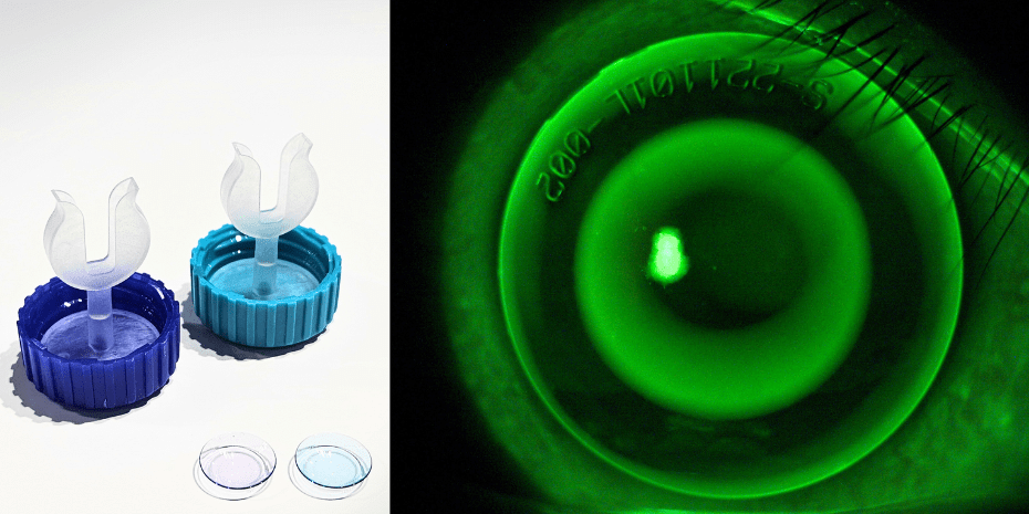 Revolutionary Designed Orthokeratology Lens